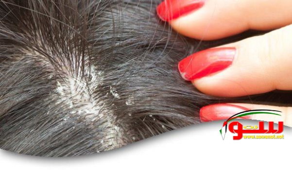 Ø³Ø¨Ø¨ Ù‚Ø´Ø±Ø© Ø§Ù„Ø´Ø¹Ø± Ù‡ÙŠ Ø¨ÙƒØªÙŠØ±ÙŠØ§ ØªØµÙŠØ¨ ÙØ±ÙˆØ© Ø§Ù„Ø±Ø£Ø³ | Ù…ÙˆÙ‚Ø¹ Ø³ÙˆØ§ 