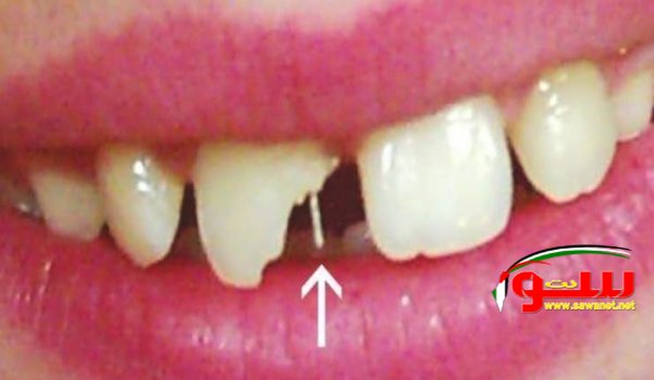  Ø·Ø±ÙŠÙ‚Ø© Ø¹Ù„Ø§Ø¬ Ø§Ù„ÙØ±Ø§ØºØ§Øª ÙˆØ§Ù„ÙƒØ³ÙˆØ± Ø¨ÙŠÙ† Ø§Ù„Ø£Ø³Ù†Ø§Ù†!! | Ù…ÙˆÙ‚Ø¹ Ø³ÙˆØ§ 