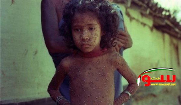 Ø§Ù„Ø£ÙˆØ¨Ø¦Ø© Ø§Ù„Ù…Ù„ÙŠÙˆÙ†ÙŠØ©.. Ù‚Ø§ØªÙ„Ø© Ø§Ù„Ø³ÙƒØ§Ù† Ø¨Ø§Ù„Ø¬Ù…Ù„Ø© | Ù…ÙˆÙ‚Ø¹ Ø³ÙˆØ§ 