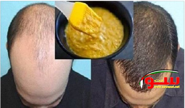  Ù…Ø§Ø³Ùƒ Ø³Ø­Ø±ÙŠ Ù„Ù†Ù…Ùˆ Ø§Ù„Ø´Ø¹Ø± ÙˆØ§Ù„Ù‚Ø¶Ø§Ø¡ Ø¹Ù„Ù‰ Ø§Ù„ØµÙ„Ø¹ Ø¨Ù…Ø¯Ø© Ù‚ØµÙŠØ±Ø© Ø¬Ø¯Ø§Ù‹ | Ù…ÙˆÙ‚Ø¹ Ø³ÙˆØ§ 